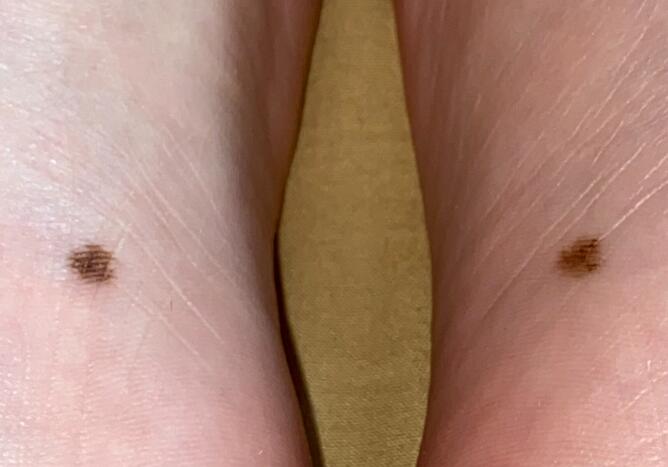 風水先生分享足底痣相解析